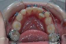 affollamento dentale, estrazioni